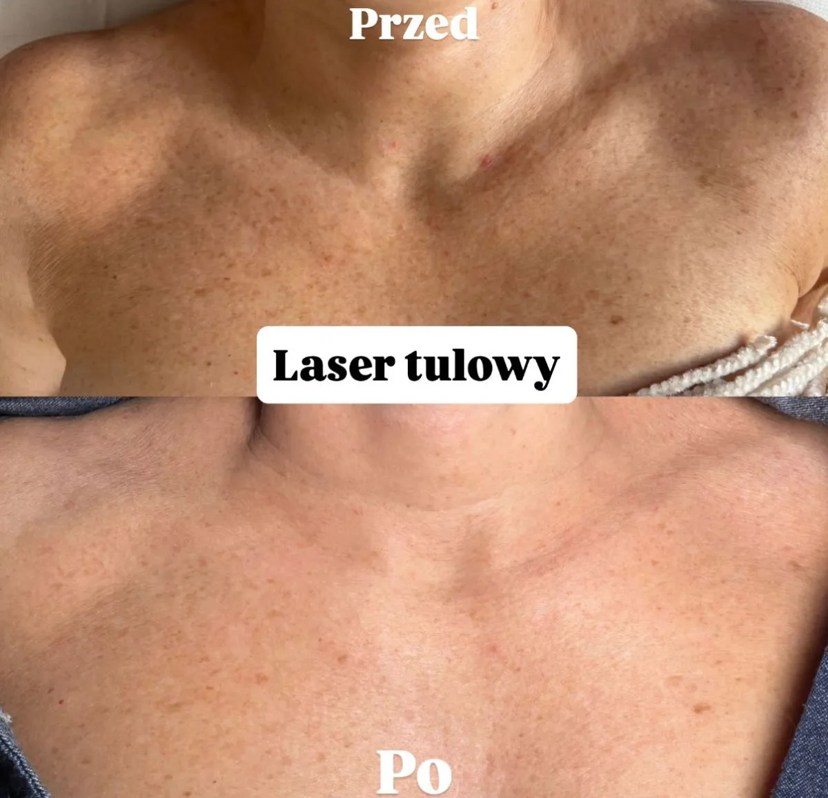 Laser tułowy, dekolt przed i po zabiegu w holi studio