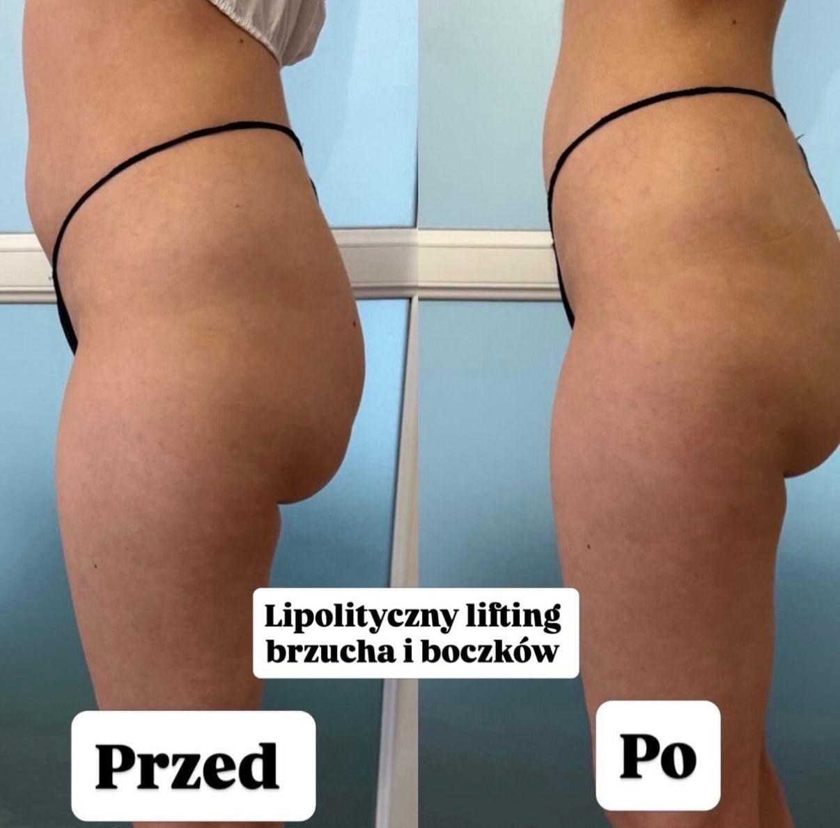 Wygładzanie cellulitu ud — holi studio Bydgoszcz