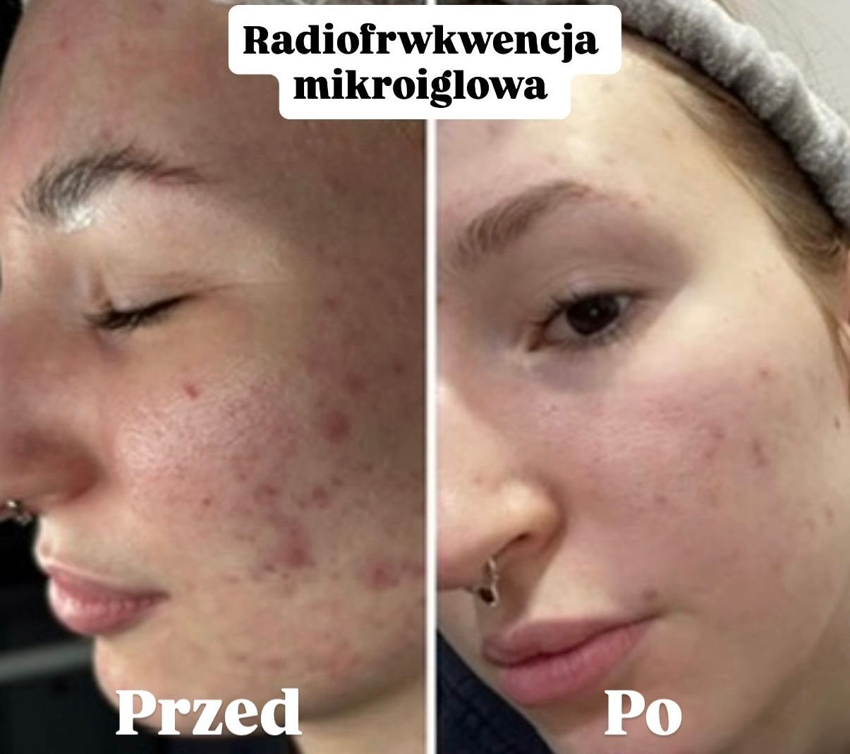 Zabieg na okolicę oka i cienie pod oczami w holi studio Bydgoszcz